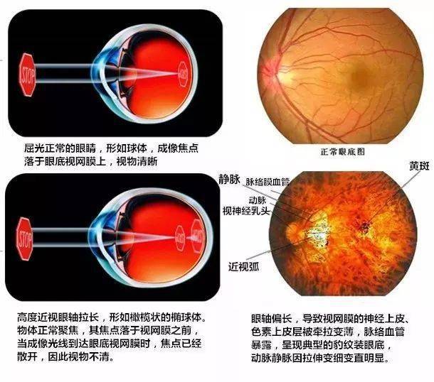 眼科眼底病英文缩写,眼科眼底病英文缩写及精细评估解析——以眼底病变为例深入探讨（附详细解析报告）,最新热门解答落实_MP90.878