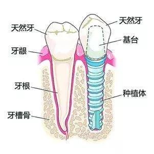 牙周病可以种植牙吗,全面分析数据，牙周病对种植牙的影响与应用分析,最新解答解析说明_WP99.10.84