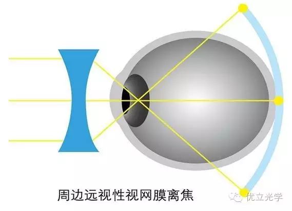 梦戴维角膜塑形镜价格散光