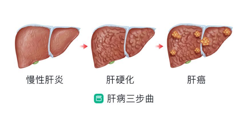 肝硬化会传染家人吗