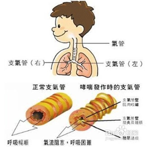 支气管哮喘的症状表现有哪些