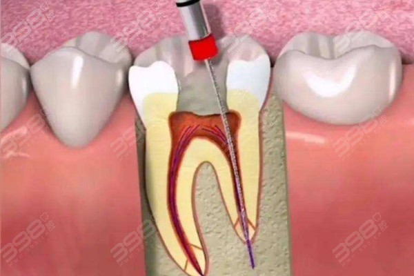 根管治疗多少钱一颗牙加牙冠