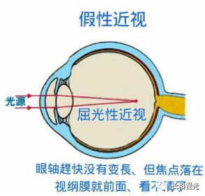 屈光不正有几种,屈光不正的类型及其权威诠释推进方式,迅速处理解答问题_升级版34.61.87