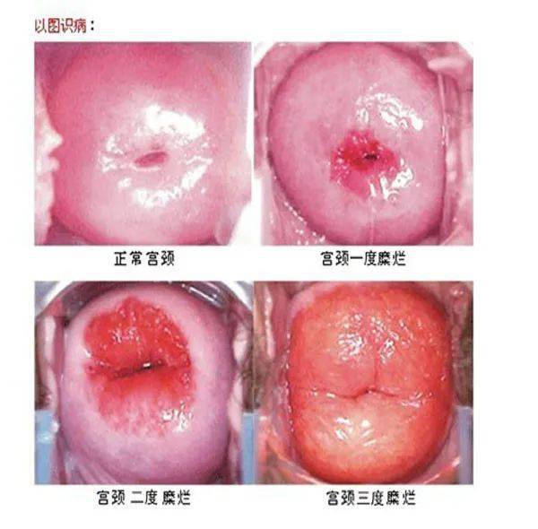 宫颈糜烂和宫颈肥大需要治疗吗