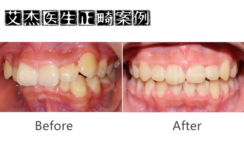 牙齿正畸牙齿酸痛正常吗,牙齿正畸过程中的牙齿酸痛，解读其正常性及动态变化,整体讲解规划_Tablet94.72.64