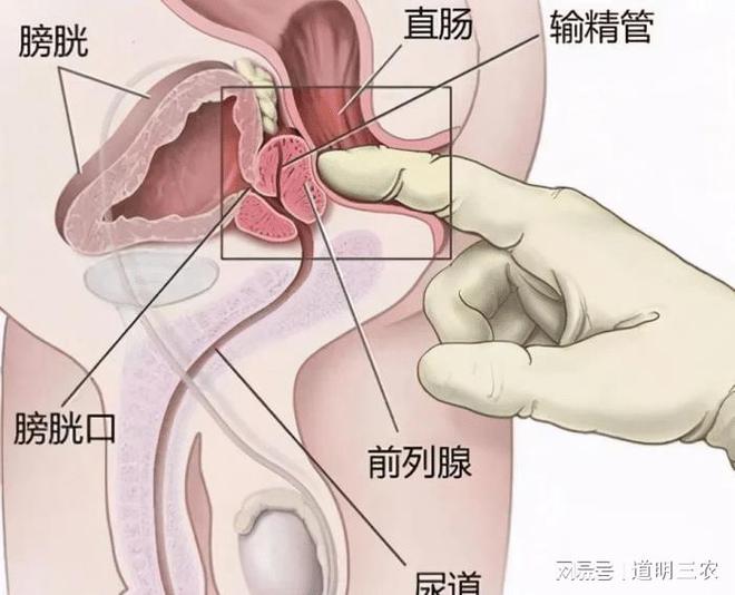 前列腺炎是怎样引起的